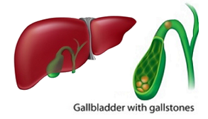 Dr. Lai Chiu Chan’s gallstones flush potent remedy