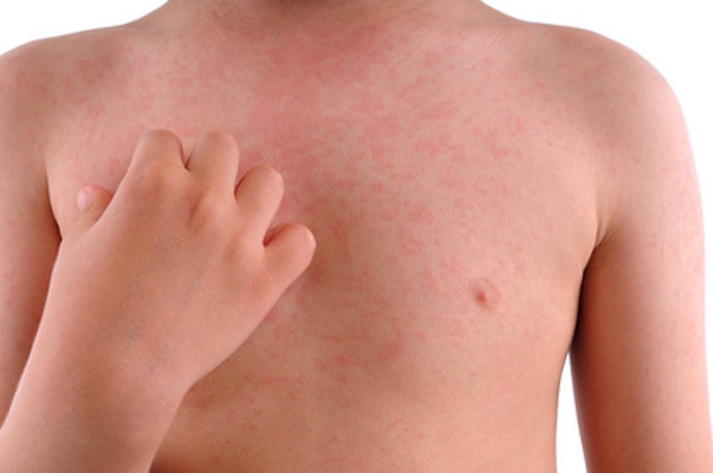 Natural remedies for hives
