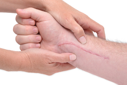The best tips for healing scars naturally