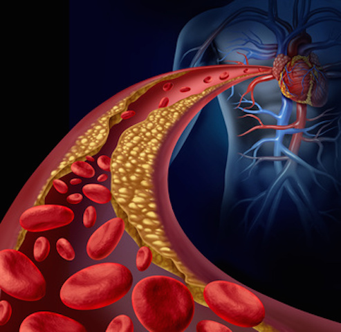 Elevated cholesterol may increase prostate cancer risk